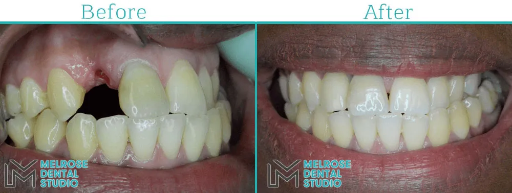 Before and after of a smile restored with Nobel Biocare dental implants, case 4
